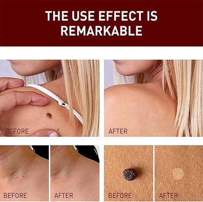 Instant Mole & Skin Tag Remover Pen