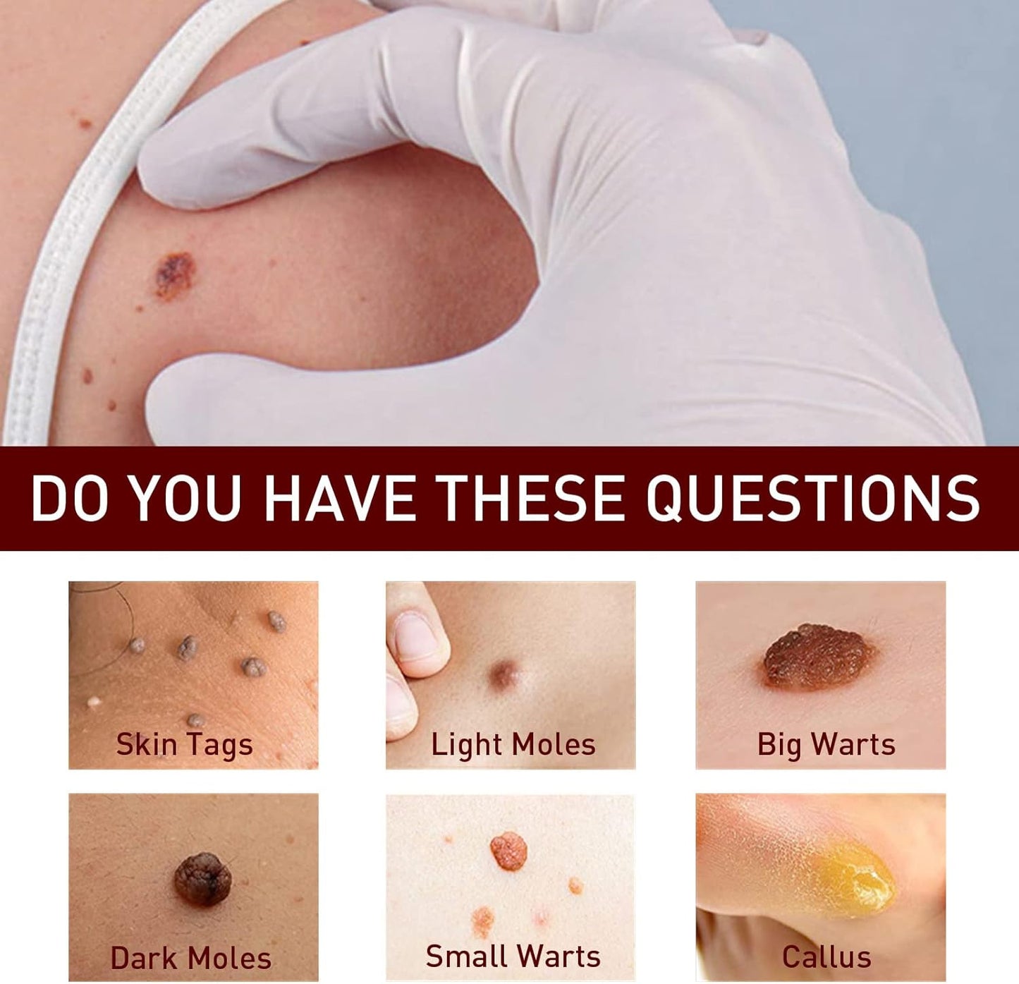 Instant Mole & Skin Tag Remover Pen