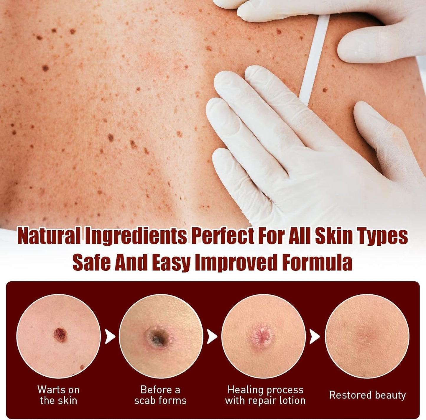 Instant Mole & Skin Tag Remover Pen