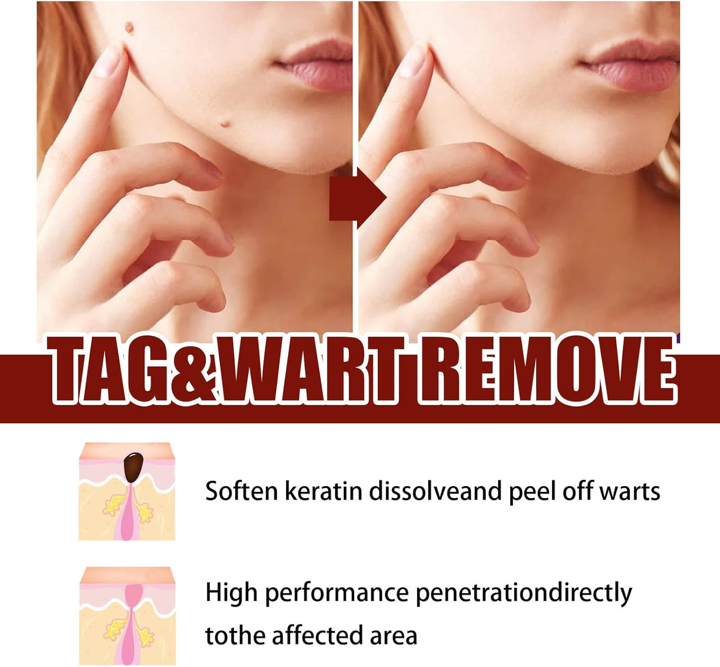 Instant Mole & Skin Tag Remover Pen