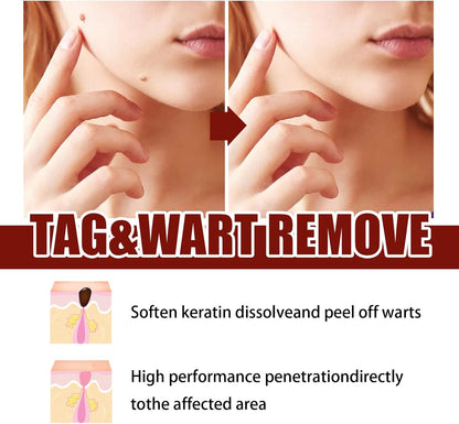 Instant Mole & Skin Tag Remover Pen